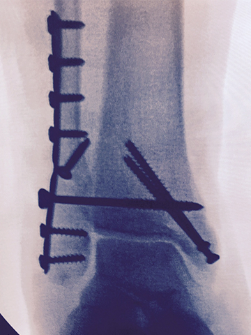 x-ray of screws and plate in my leg due to broken ankle